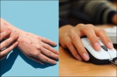 Monkeypox and computer mouse