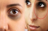 Home Remedies for Dark Circles