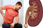Kidney Stone diet