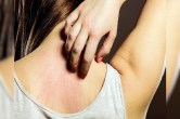 Itching Problem