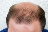Baldness