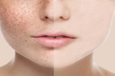 Pigmentation