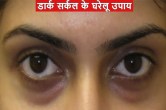 Dark Circles Home Remedies
