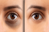 Dark Circle Removal Tips How to remove Dark Circles