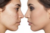 Skin Care TIPS How to remove wrinkles pimples and spots on the face