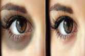 Dark Circles Remove with banana peel how to remove dark circles
