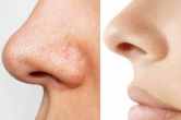 Blackhead Removal Tips