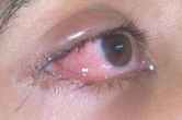 Eye Flu Case Increased In Rajasthan