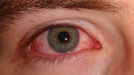 Eye Flu