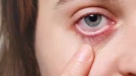 Eye flu outbreak in Chhattisgarh
