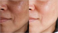 Skin Care Tips