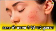 Acne, pimples, diet, nutrition, skin, clear skin, healthy skin, food food items, diet for acne, acne-fighting foods, how to eat for clear skin