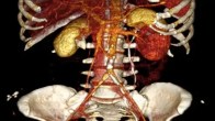 Bhilai Three Kidney News, Bhilai News, Chhattisgarh News, Kidney News