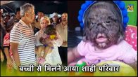 Malaysia, Werewolf Syndrome, hypertrichosis, Girl with Werewolf Syndrome