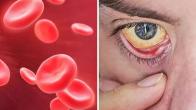 low hemoglobin treatment,low hemoglobin symptoms,what type of cancer causes low hemoglobin,dangerously low hemoglobin levels,is 7.6 hemoglobin dangerous,low hemoglobin causes,how to increase hemoglobin,hemoglobin normal range,symptoms of dying from anemia,what type of cancer causes low hemoglobin