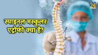spinal muscular atrophy treatment,spinal muscular atrophy symptoms,spinal muscular atrophy causes,spinal muscular atrophy type 1,spinal muscular atrophy type 2,spinal muscular atrophy life expectancyspinal muscular atrophy injection cost,spinal muscular atrophy types