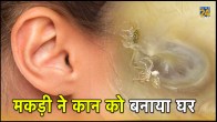 Spider, Ear, New England Journal of Medicine, ENT disease