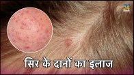 Hair Scalp Acne Bacterial
