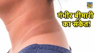 Acanthosis Nigricans,dark neck treatment,how to get rid of black neck overnight,dark pigmentation around neck,dark neck causes in child,dark neck diabetes,dark neck treatment cream,dark patches on neck,acanthosis nigricans