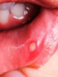 Mouth Ulcer Remedies
