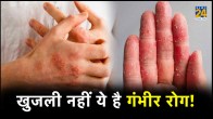 treatment for eczema, eczema pictures, eczema causes, eczema cream, how to cure eczema permanently eczema symptoms, eczema types, causes of eczema in adults, skin conditions, itching, eczema