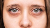 dark circles