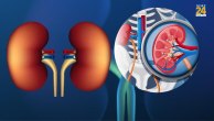 kidney stone
