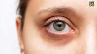 dark circles causes