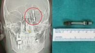 Mind Surgery
