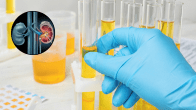 AI Advice On Kidney Stone Passing