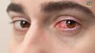 Avoiding Eye Infections
