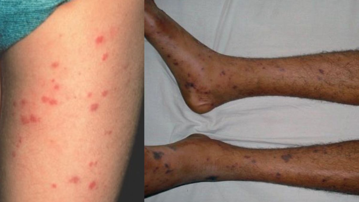Meningococcal Bacteria