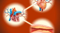 blockage in the artery