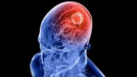 Brain Tumour