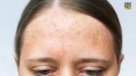 small bumps on forehead