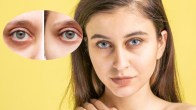 DARK CIRCLES PROBLEMS