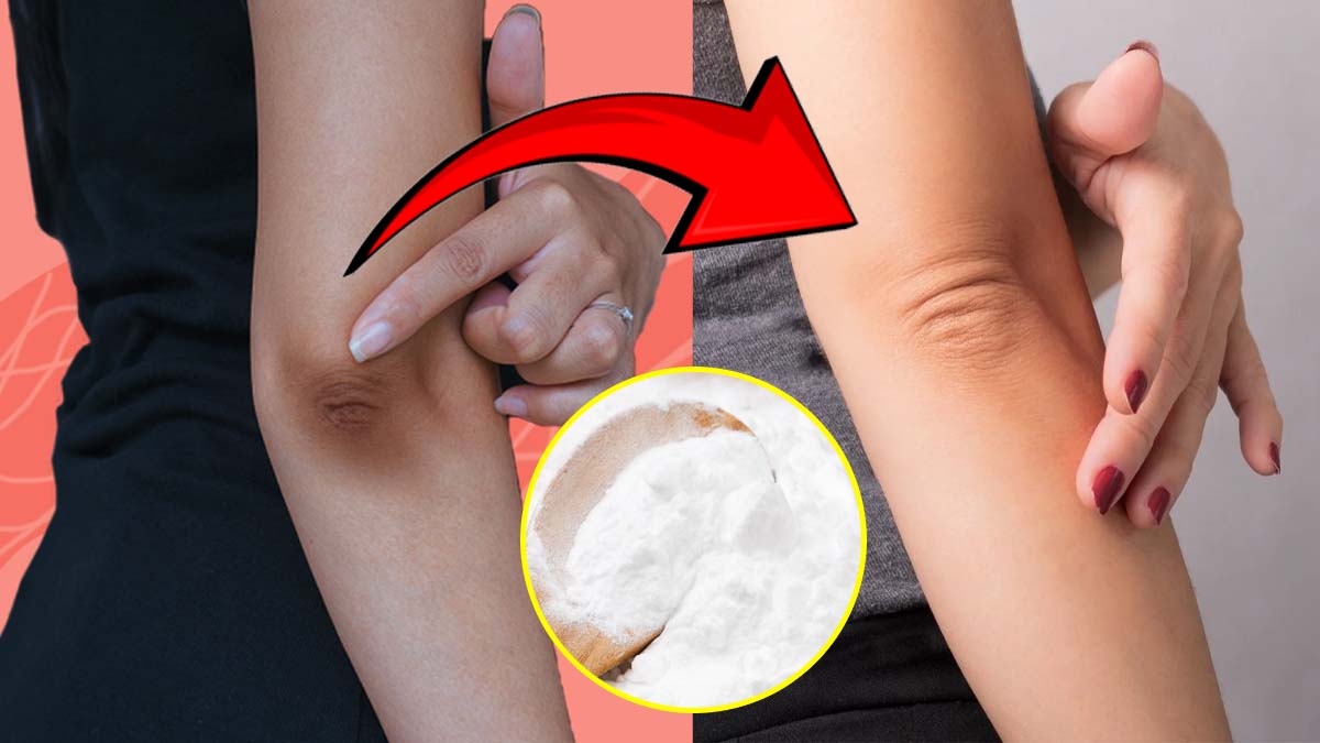 dark elbows home remedies
