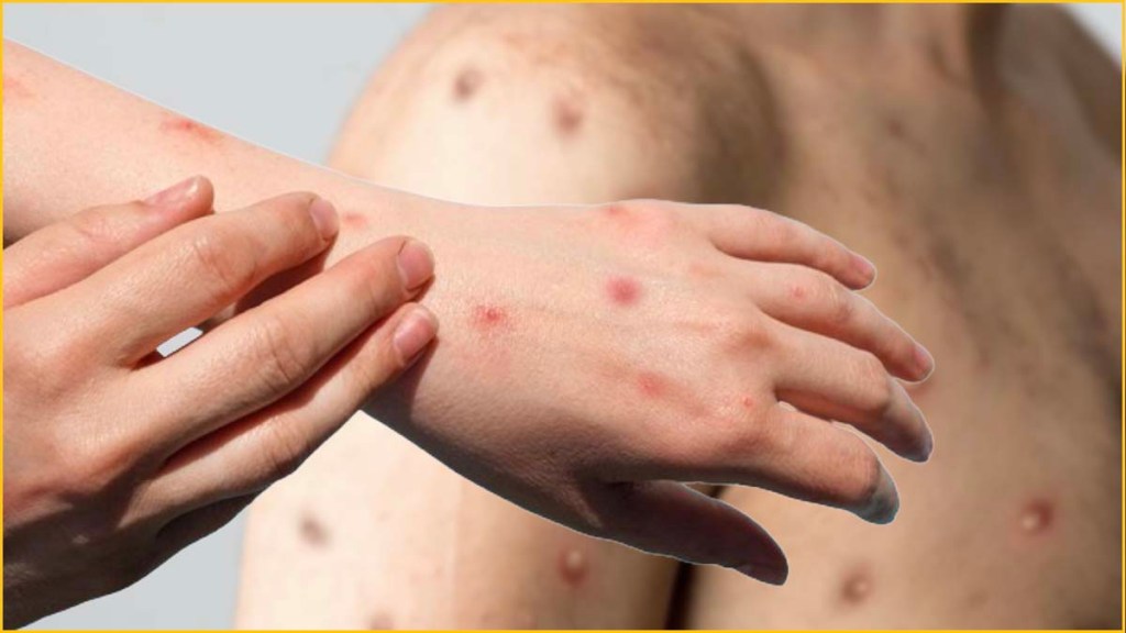 Mpox