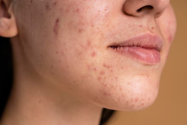 Side effects of besan