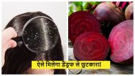 How to get rid of dandruff