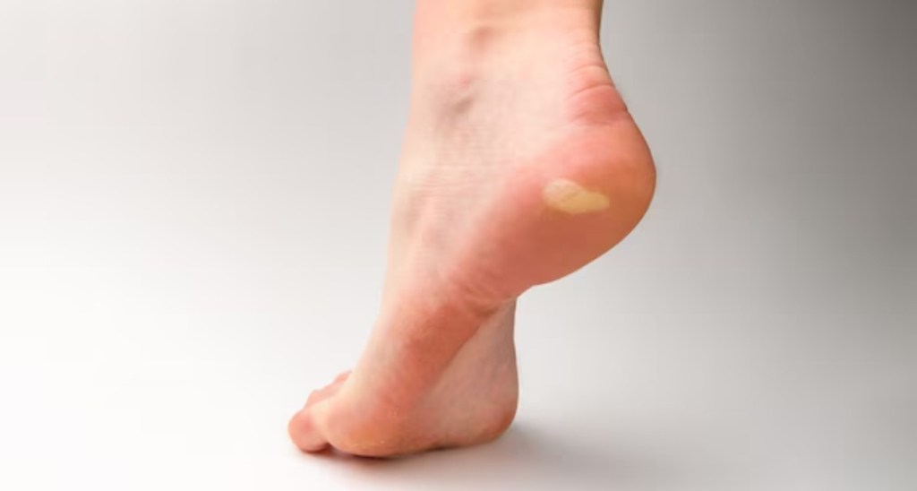 Diabetes Sign Foot corn 