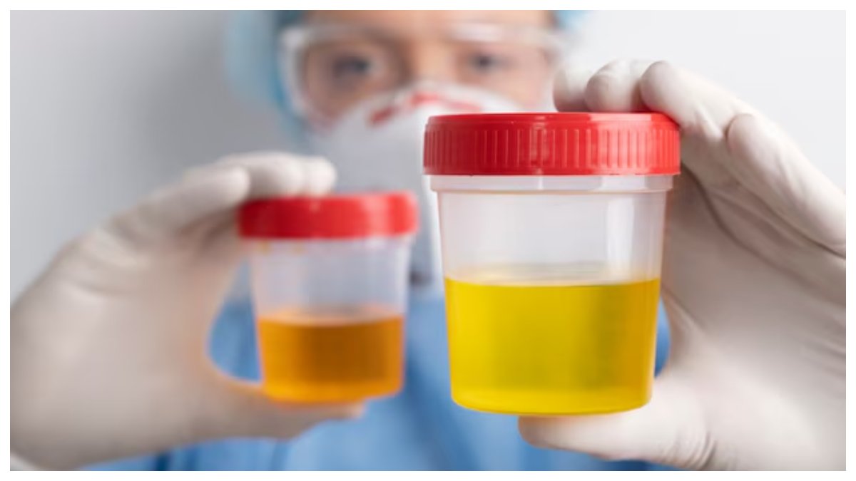 URINE COLOR SYMPTOMS