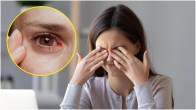 ICL Surgery Eyes