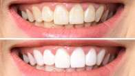 Teeth Brightening Remedies