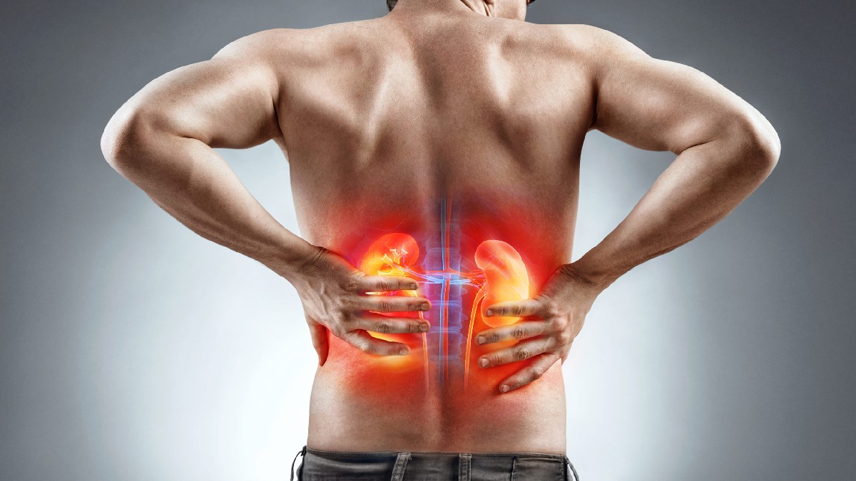 kidney Stone Signs