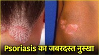 Psoriasis