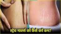 Stretch Marks