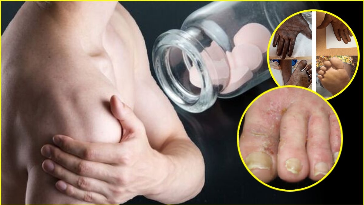 Vitamin b 12 deficiency