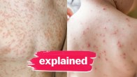 Measles and Rubella Disease