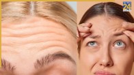 Forehead Lines